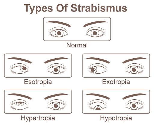 Types of Strabismus